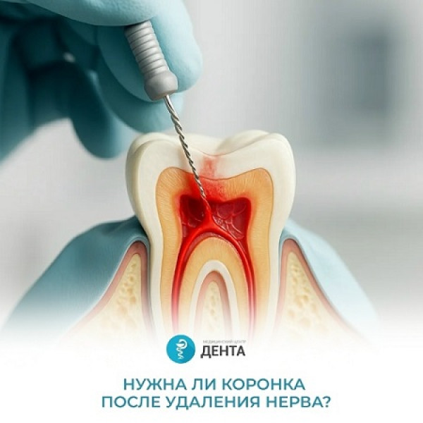 Нужна ли коронка после удаления нерва?