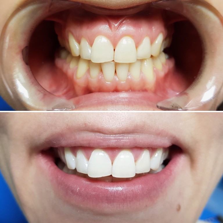 Вредно ли отбеливание зубов отзывы портативный ирригатор rl650